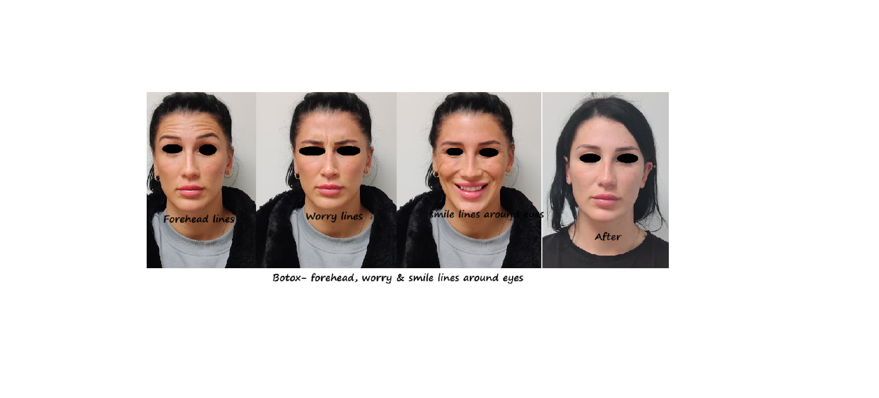 Before & after photos botox upper face – fresher, more appealing and more alert appearance.