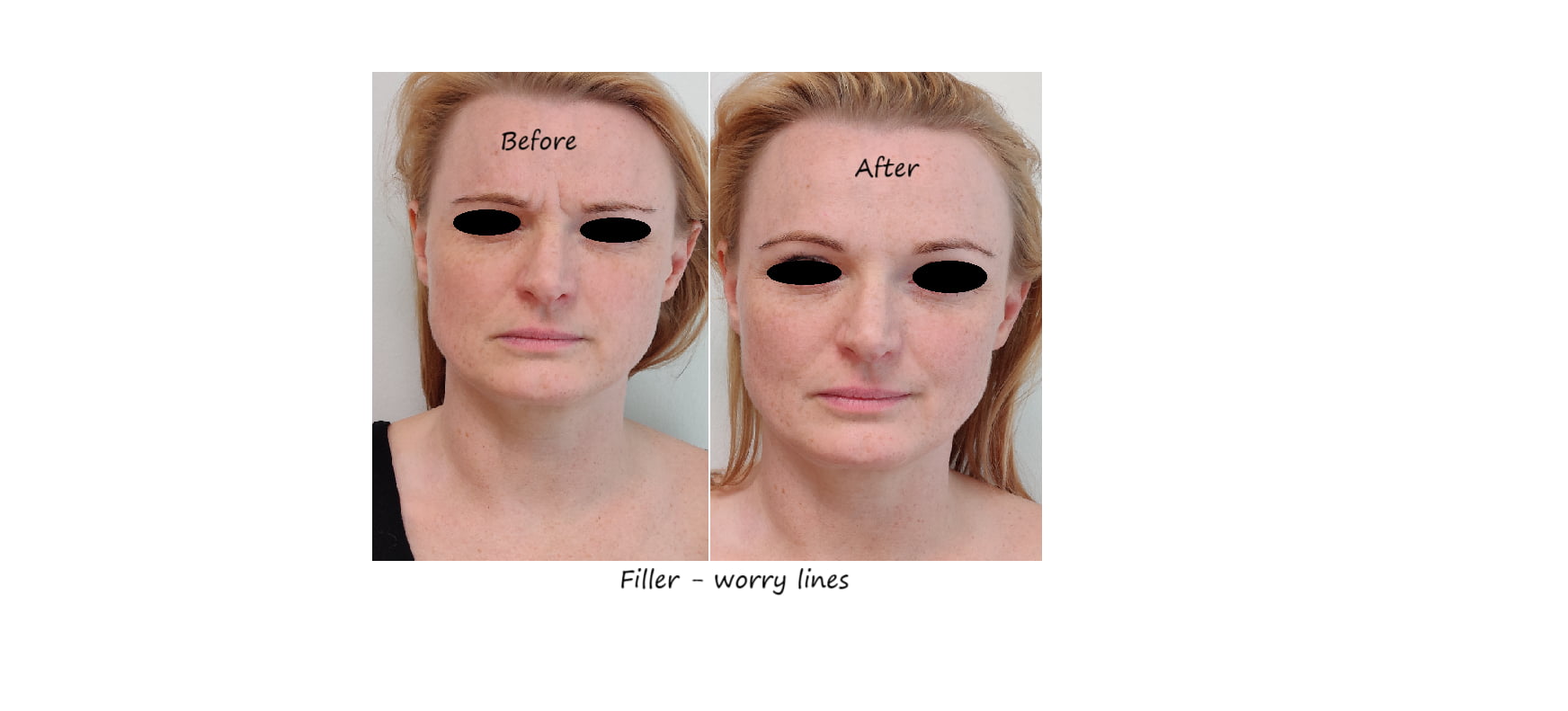 Before and after photos glabella filler – reduced wrinkles and smoother forehead.
