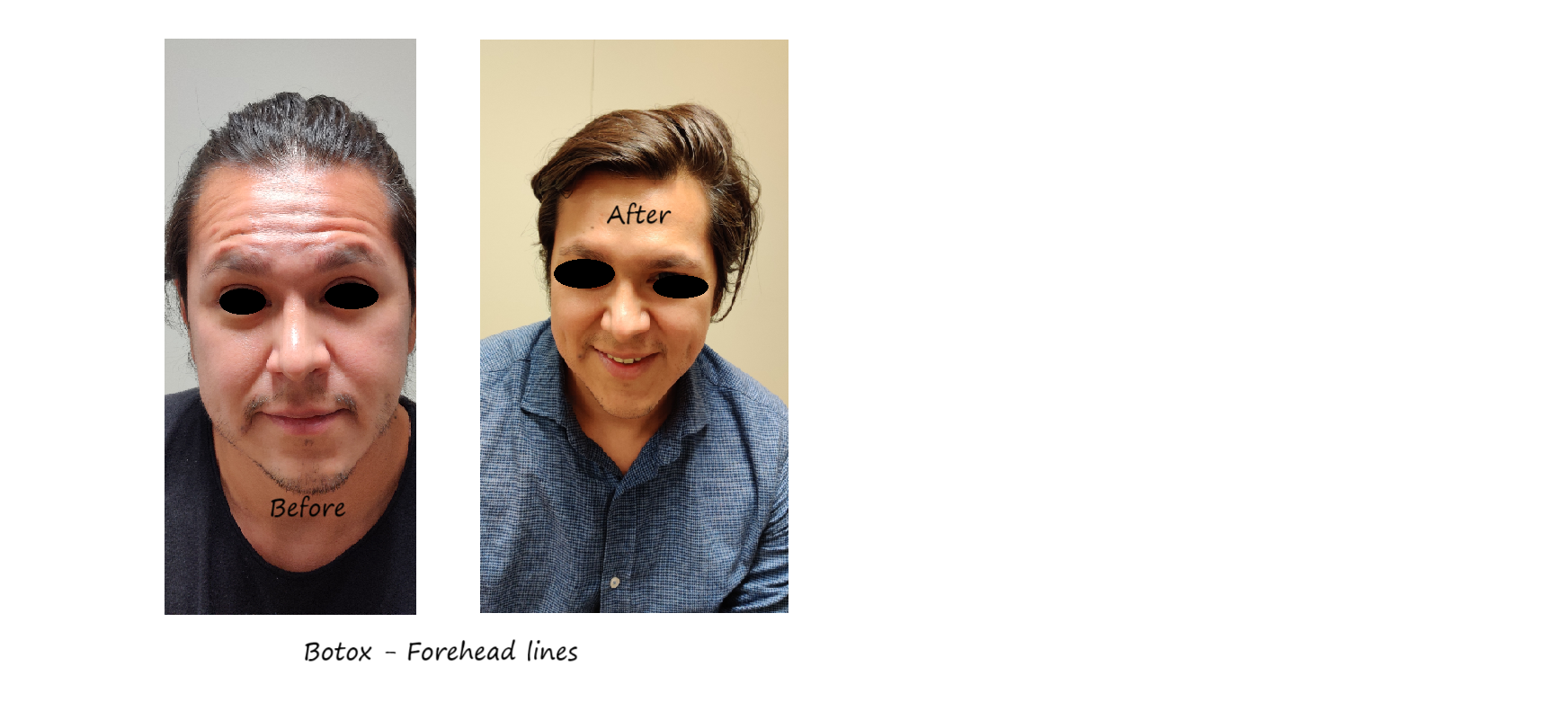 Before and after photos of botox in the forehead - reduced wrinkles and natural eyebrow shape.