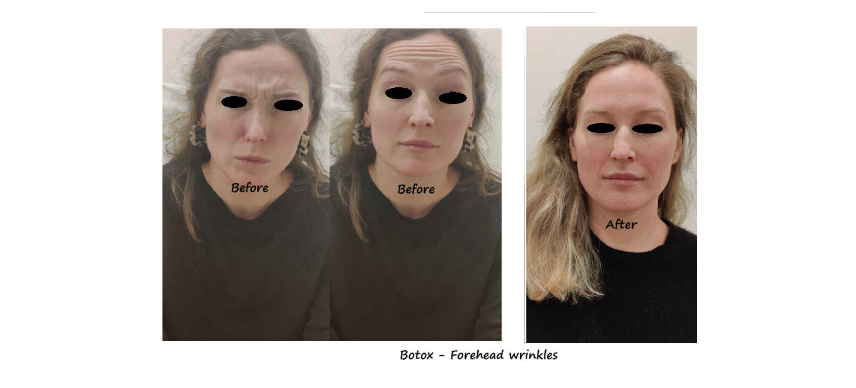 Botox treatment in the forehead and glabella – before and after photos showing reduced wrinkles.