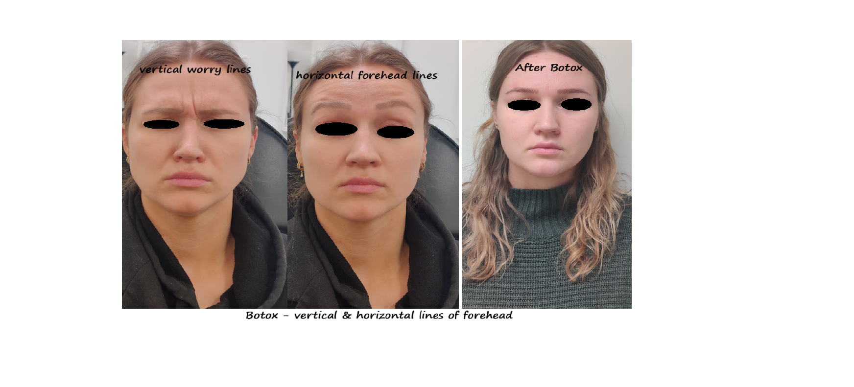 Botox forehead & glabella before and after photo – smooth forehead and youthful appearance.