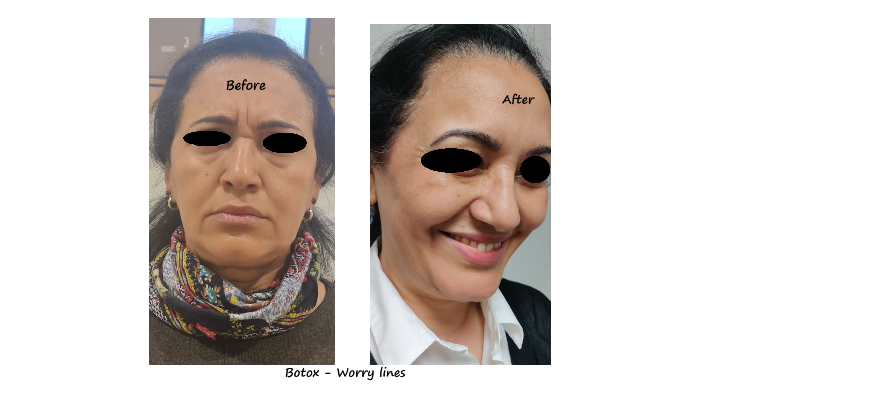Before & after photos botox frown wrinkles – smoother glabella & relaxed expression.