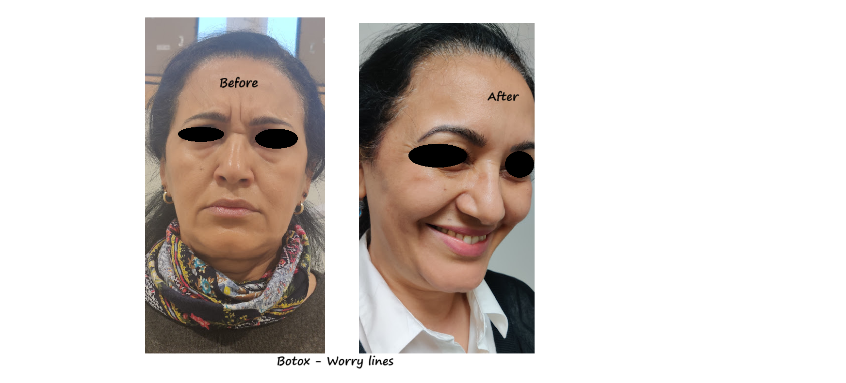 Before & after photos botox worry wrinkles – smoother glabella & relaxed expression.