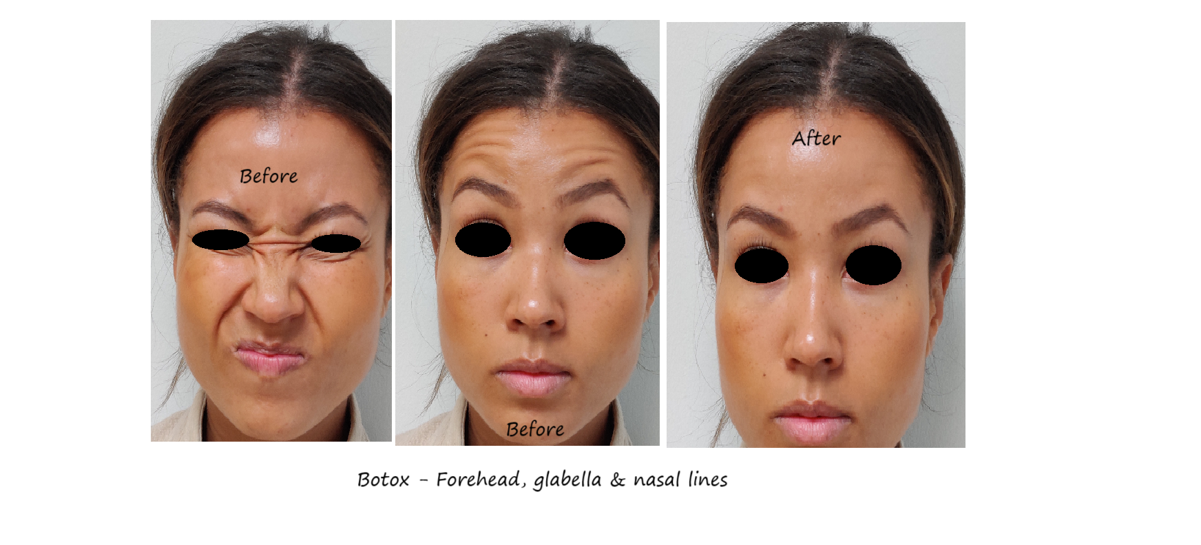 Before and after image botox forehead, nose & glabella – smoother upper face and younger appearance.
