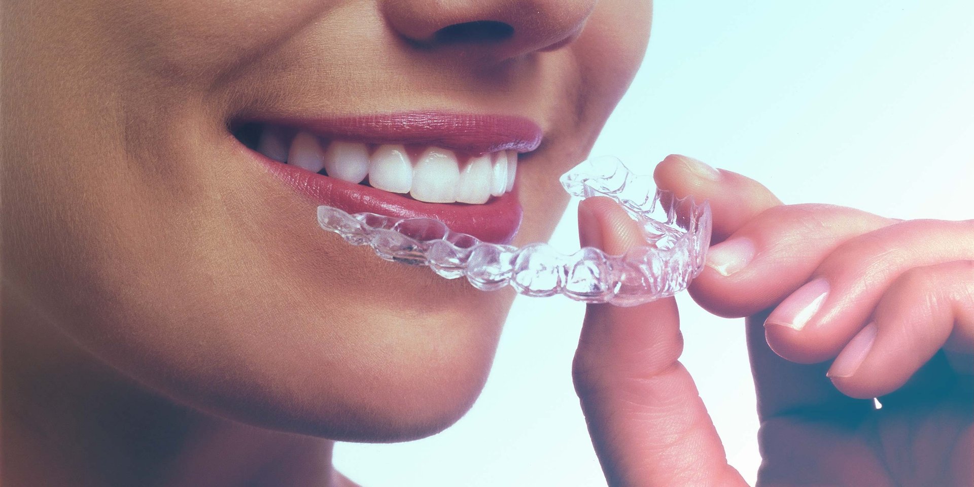 aparat dentar pret