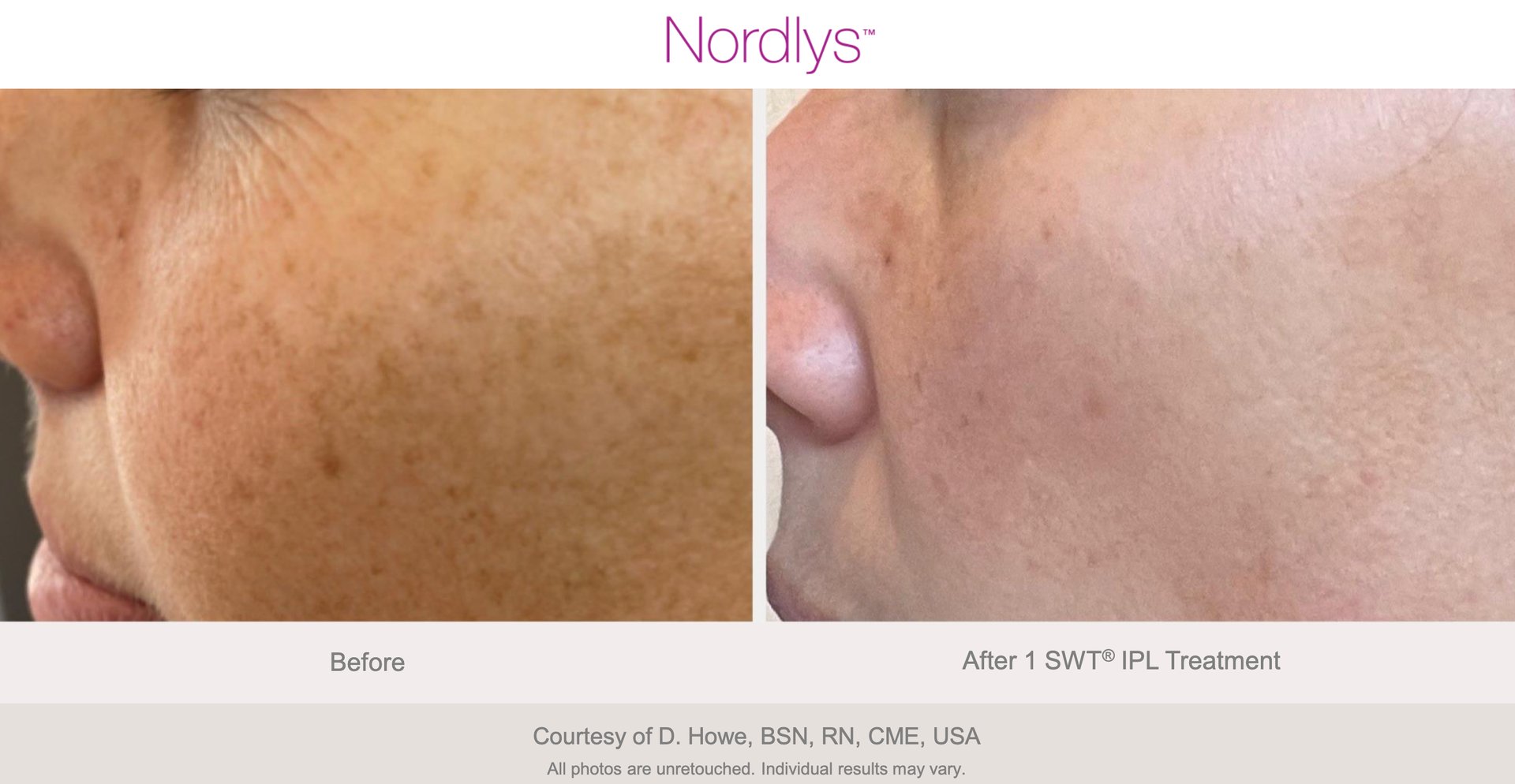 Professional hyperpigmentation skin treatment for skin, Hamilton, Ontario Skin Clinic