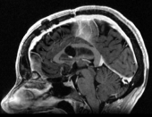 Ressonância após a cirurgia no cérebro com remoção do cisto colóide e resolução da hidrocefalia.