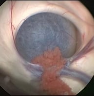 CHOROID PLEXUS