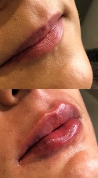 Preenchimento labial natural, sem exageros. Tecnica lipkiss
