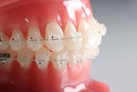 ceramic or tooth coloured braces