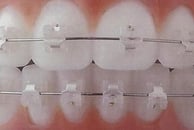 ceramic self ligation braces