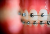 Metal Self Ligation braces