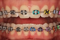 Metal braces