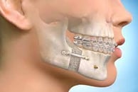 Orthognatic Surgery