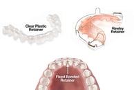 Retainers