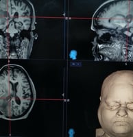 Intra-operative cortical stimulation