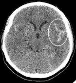 Tomografia de crânio revelando hemorragia intracerebral.