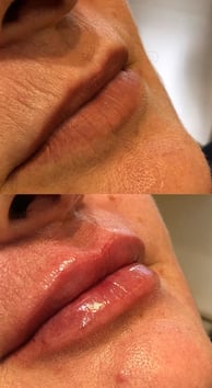 Preenchimento labial natural, sem exageros. Tecnica lipkiss