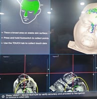 Neuro-navigation during surgery