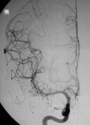 Angiografia carotiídea após a cirurgia no cérebro e ressecção da MAV.