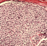 Breast Cancer cells