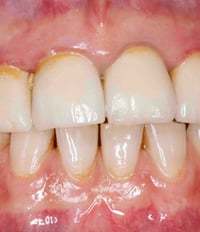 tooth cleaning in baner
