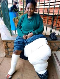 a woman with a castor cast on her leggings