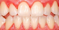 inflammation gencives gingivite
