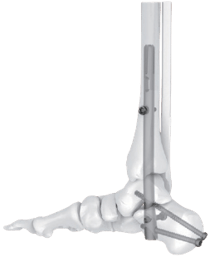 Clavo Intramedular para Artrodesis de Tobillo