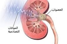 الموجات التصادمية علاج الحصوات