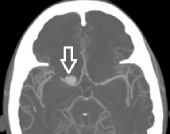 Angiotomografia corte axial mostrando o aneurisma cerebral (seta).