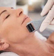 Skin Needling Benefits You Can’t Ignore!