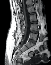 Low lying spinal cord