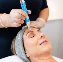 Skin Needling Benefits You Can’t Ignore!