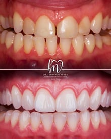 a before and after image of dental treatment