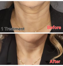 RF Microneedling before and after only one treatment