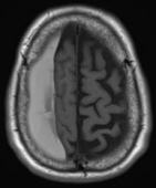 Ressonância de homem de 50 anos com cefaleia há 3 meses. Volumoso hematoma subdural crônico.