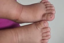 Foto malformações, procedimento cirúrgico realizado pelo Dr. Humberto Forte Cirurgião Pediátrico