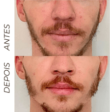 preenchimento de mandibula em barbacena Define o contorno da mandíbular