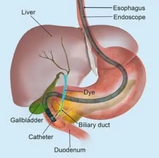Endoscopic retrograde cholangiopancreatography GASTRO FOUNDATION