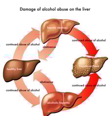Alcoholic hepatitis GASTRO FOUNDATION