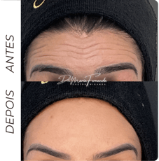 Botox em Barbacena para redução de rugas dinâmicas e prevenção de linhas de expressão
