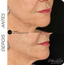 Fios de PDO em barbacena para Promove o lifting facial não cirúrgico e estimula colágeno.