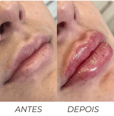Preenchimento labial em Barbacena Proporciona volume, definição e hidratação aos lábios
