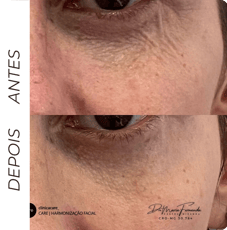skinbooster em barbacena Reduz linhas finas, melhora a elasticidade e dá um brilho saudável.