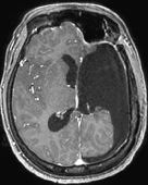 Ressonância após a cirurgia no cérebro (hemisferotomia). Ela se curou da epilepsia.