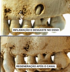 tomografia mostrando perfuração no osso e a regeneração do osso após o canal