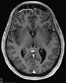 Ressonância após a cirurgia no cérebro com a remoção total do cisto colóide e sem hidrocefalia.