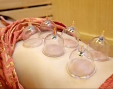 Cupping therapy