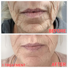 RF Microneedling before and after only one treatment